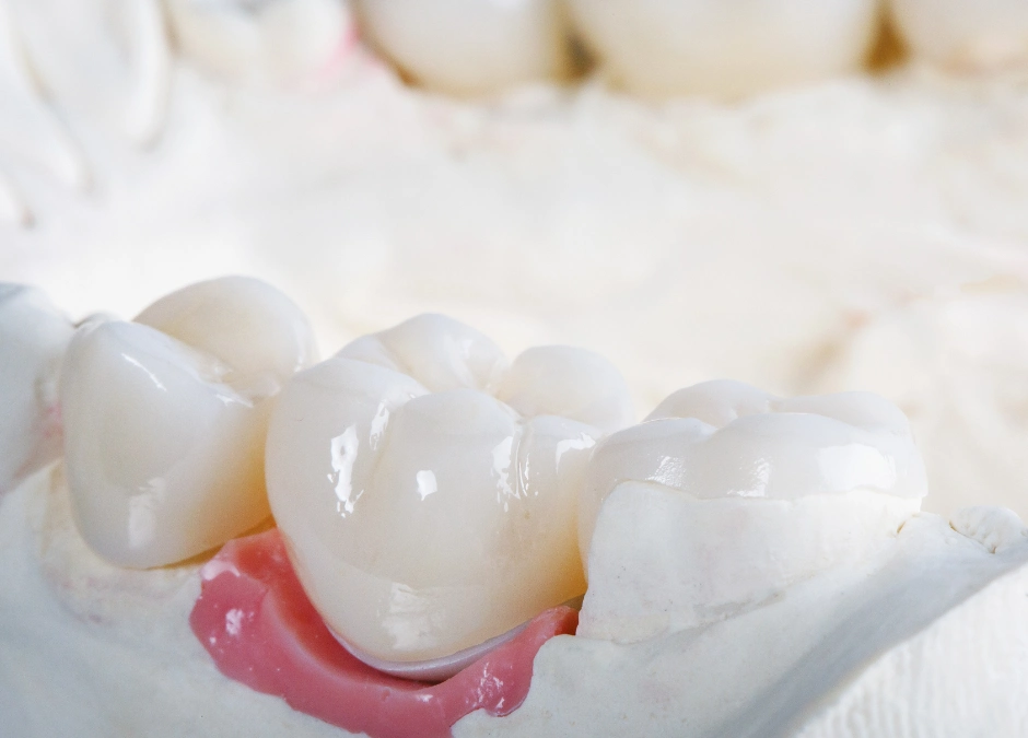 Everything You Should Know About Different Dental Crown Types